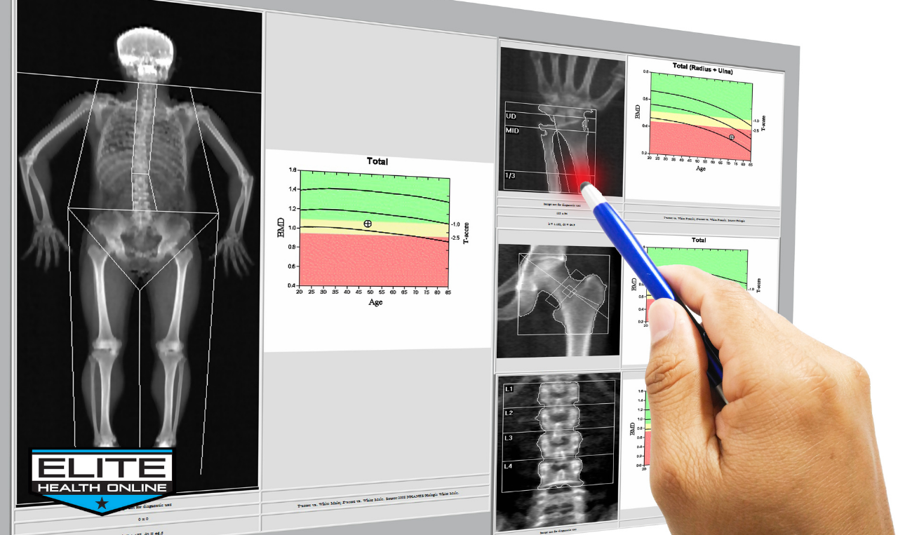 Bone Density and Testosterone